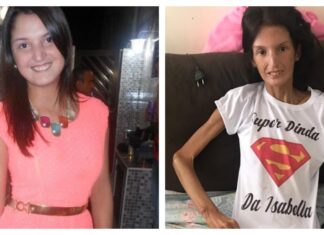 Jovem que chegou a pesar 34 kg por causa de doença rara morre após 8 anos de luta