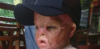 Menino se prepara para a 9ª cirurgia após ter 100% do rosto queimado por óleo em acidente