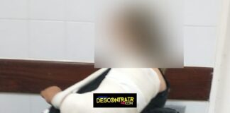 TOBIAS BARRETO: Mulher tem braço quebrado após dois homens em uma moto, na contramão, colidir em sua biz.