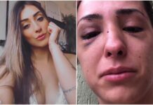 Modelo fica com rosto deformado ao ser espancada por terminar namoro