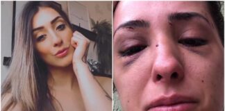 Modelo fica com rosto deformado ao ser espancada por terminar namoro
